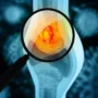 Penyebab Kanker Tulang Menurut WHO, Genetik hingga Paparan Radiasi